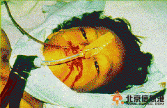 埃博拉疫情首襲中東 埃博拉病毒病人圖片如僵尸活死人