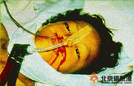 【膽小勿進】埃博拉病毒病人圖片如僵尸 埃博拉病毒復活可產生“活死人”