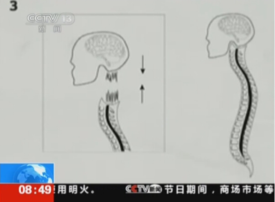 意大利首例人類“換頭手術”將實施 估計需36小時才能完成