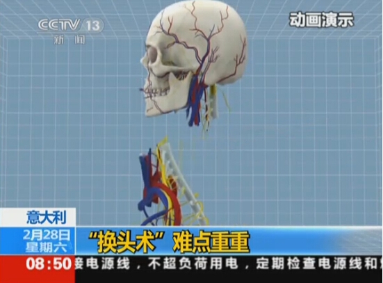 意大利首例人類“換頭手術”將實施 估計需36小時才能完成